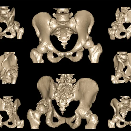 CT 3D Left Hip Joint